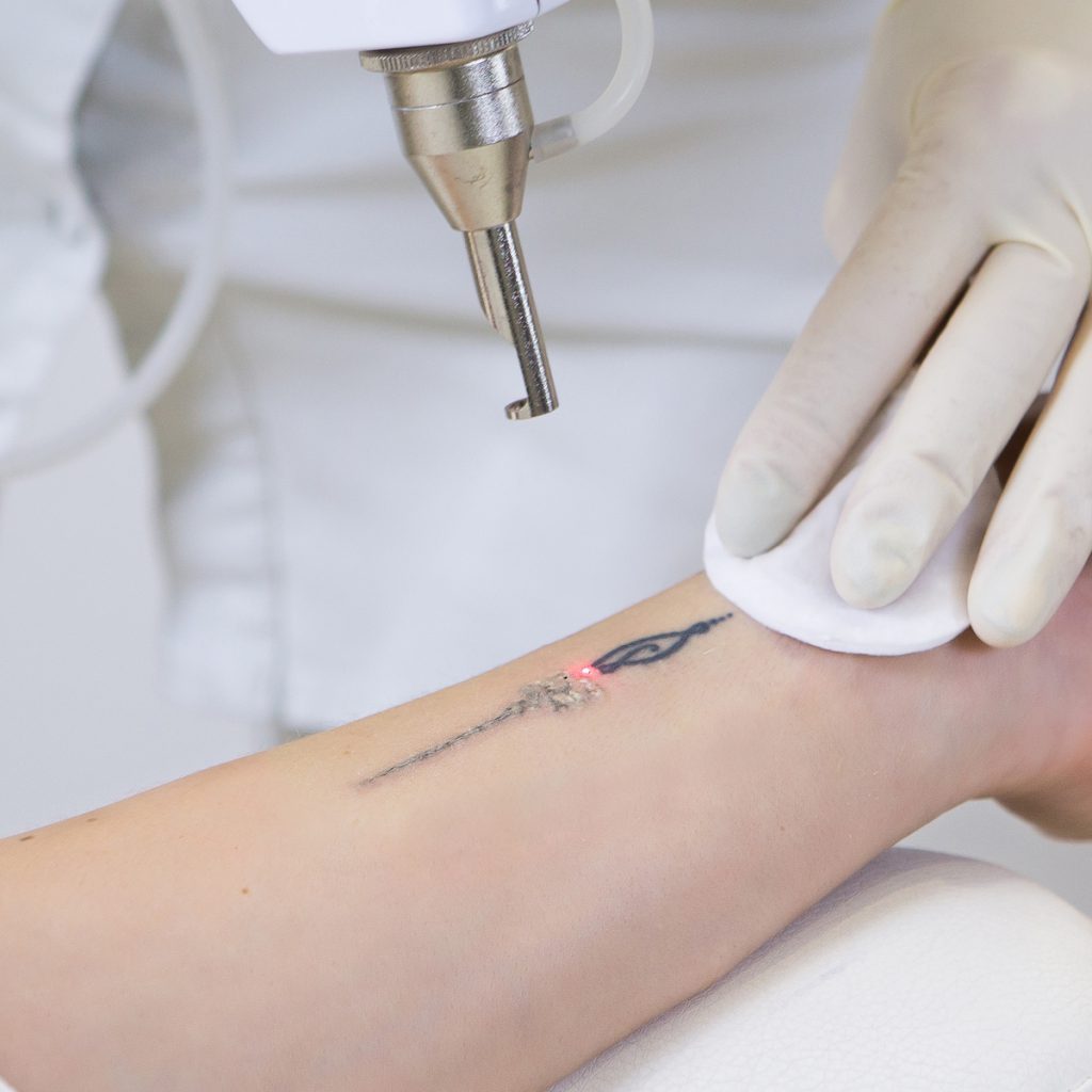 Tattoo Laser Removal Treatment - Our Treatments - ABC Clinic abcclinc